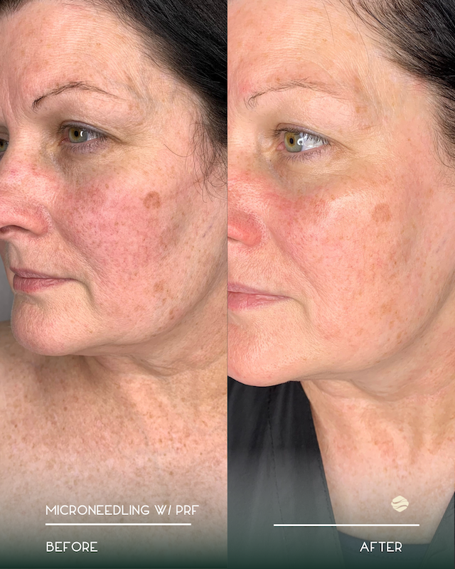 If you're curious what is micro needle therapy in Milton, GA, this before and after image shows a woman's skin with less hyperpigmentation and fewer sun spots after treatment.